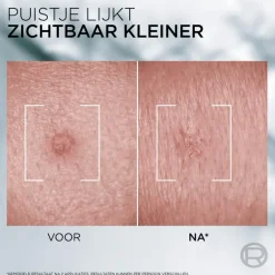 L'Oréal Men Expert Derma Control Pimple Paste - 45ML